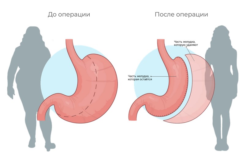 Бариатрическая операция